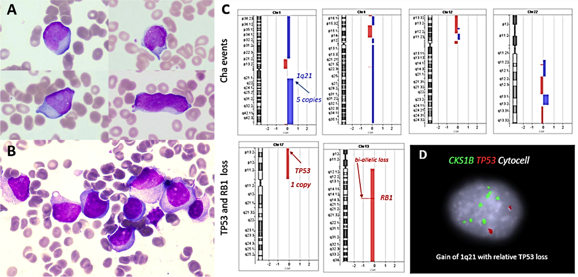 Secondary plasma cell leukaemia (PCL) with plasmablastic morphology