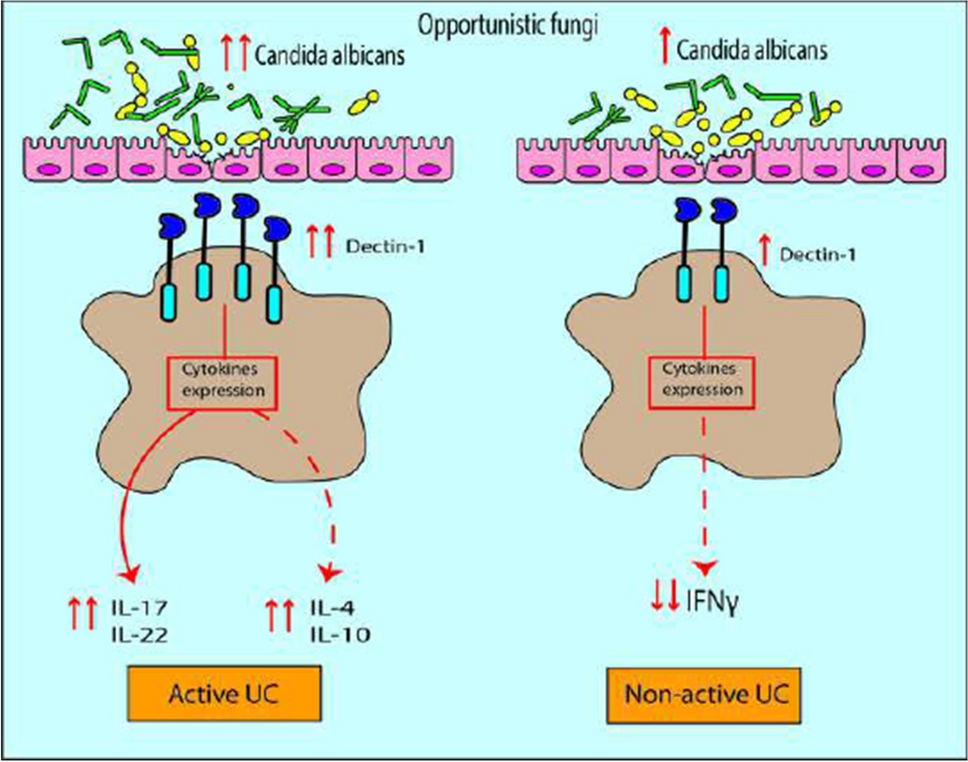 Possible role of intestinal fungal dysbiosis in dectin-1 and cytokines expression in patients with ulcerative colitis