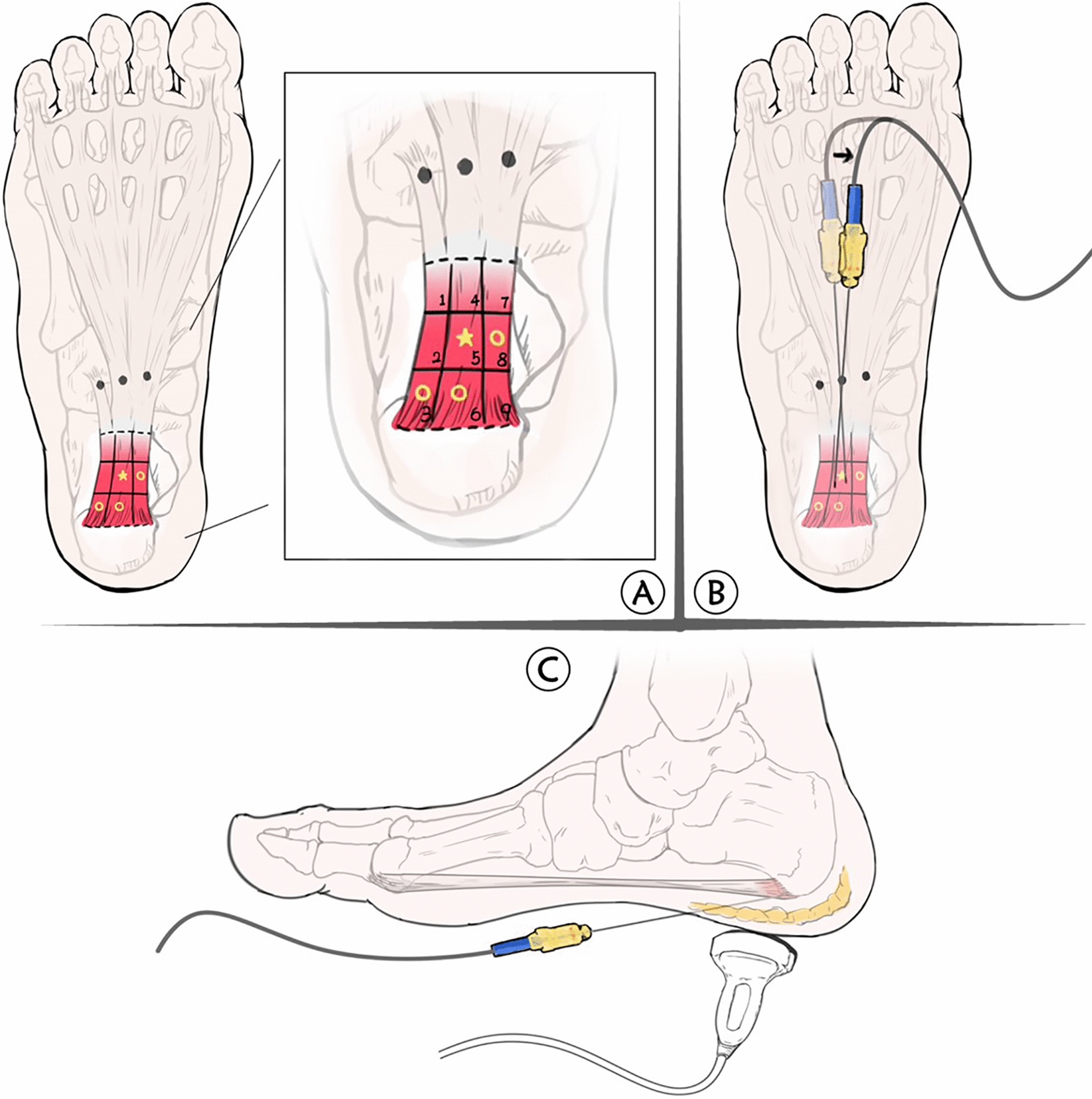 A Novel Combination Strategy of Ultrasound-Guided Percutaneous Radiofrequency Ablation and Corticosteroid Injection for Treating Recalcitrant Plantar Fasciitis: A Retrospective Comparison Study