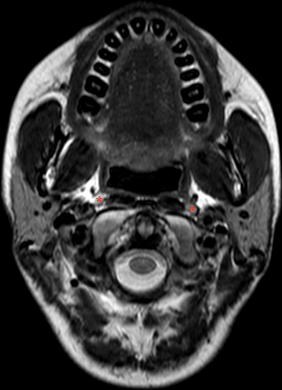 Ganglionic Local Opioid Analgesia at the Superior Cervical Ganglion: MRI-Verified Solution Spread