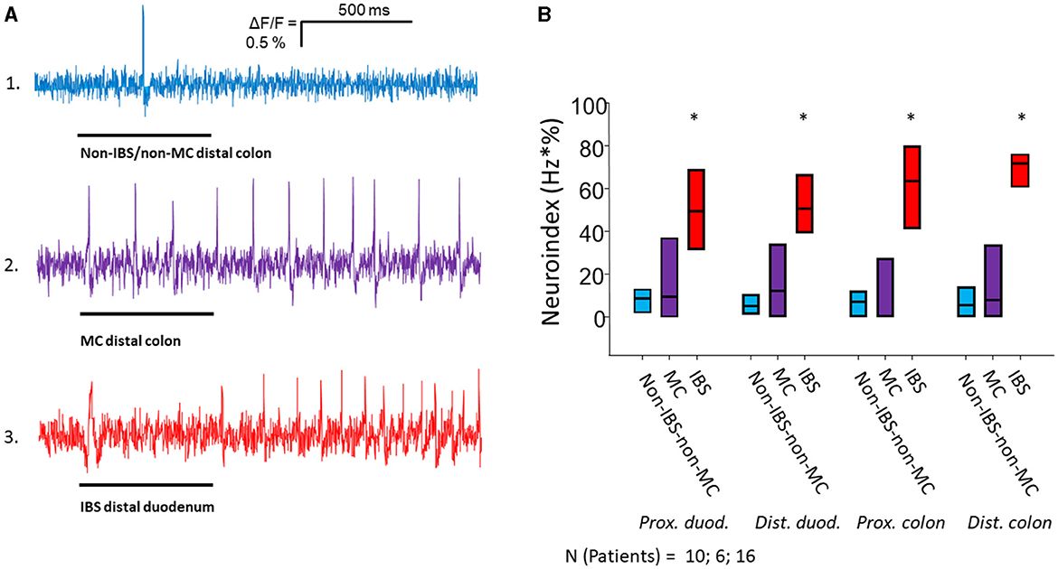 Biopsy samples from patients with irritable bowel syndrome, but not from those with mastocytosis or unspecific gastrointestinal complaints reveal unique nerve activation in all gut regions independent of mast cell density, histamine content or specific gastrointestinal symptoms