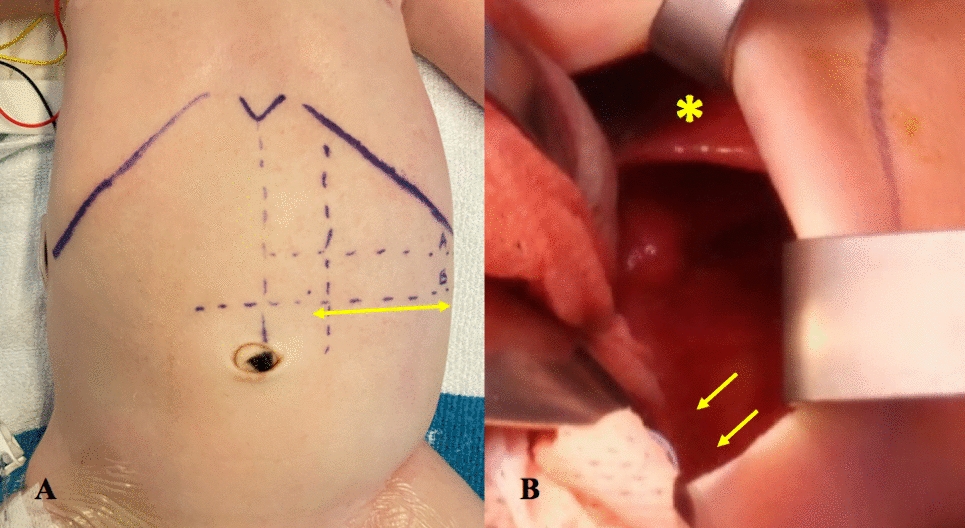 Abdominal wall muscle weakness outcomes after split abdominal flap repair of large congenital diaphragmatic hernias in newborn