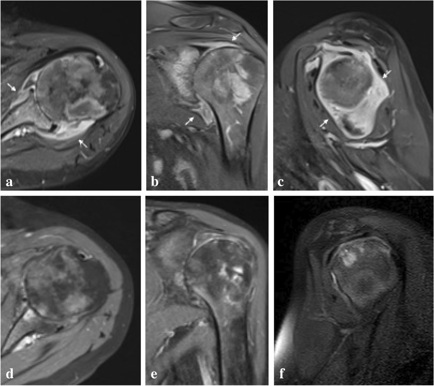 Successful treatment of a rheumatoid arthritis patient with severe synovial hypertrophy and impaired shoulder function with microwave ablation technique