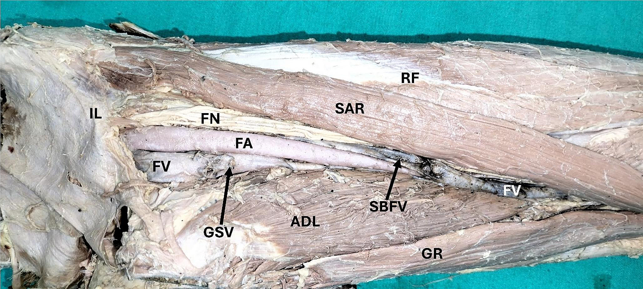 A rare femoral venous ladder encircling the femoral artery