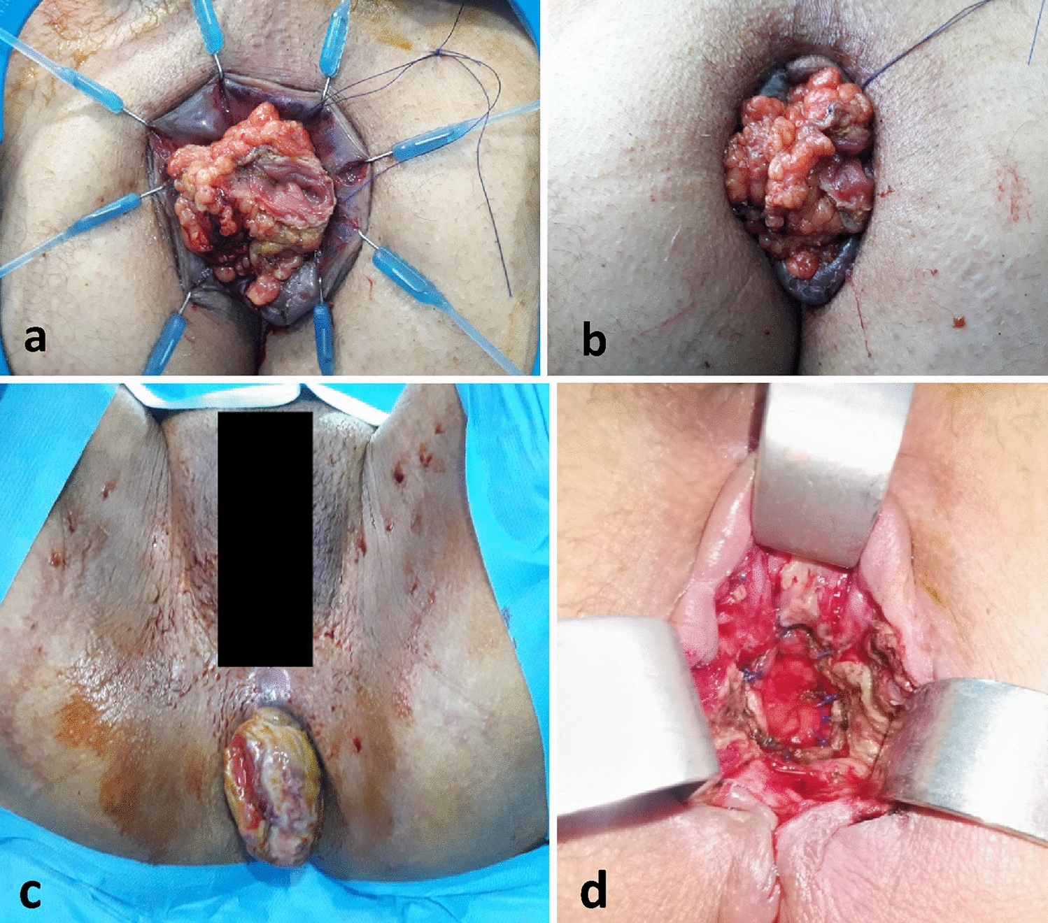 Modified delayed coloanal anastomosis following TME for mid and low rectal cancer: 19 consecutive patients from a single center