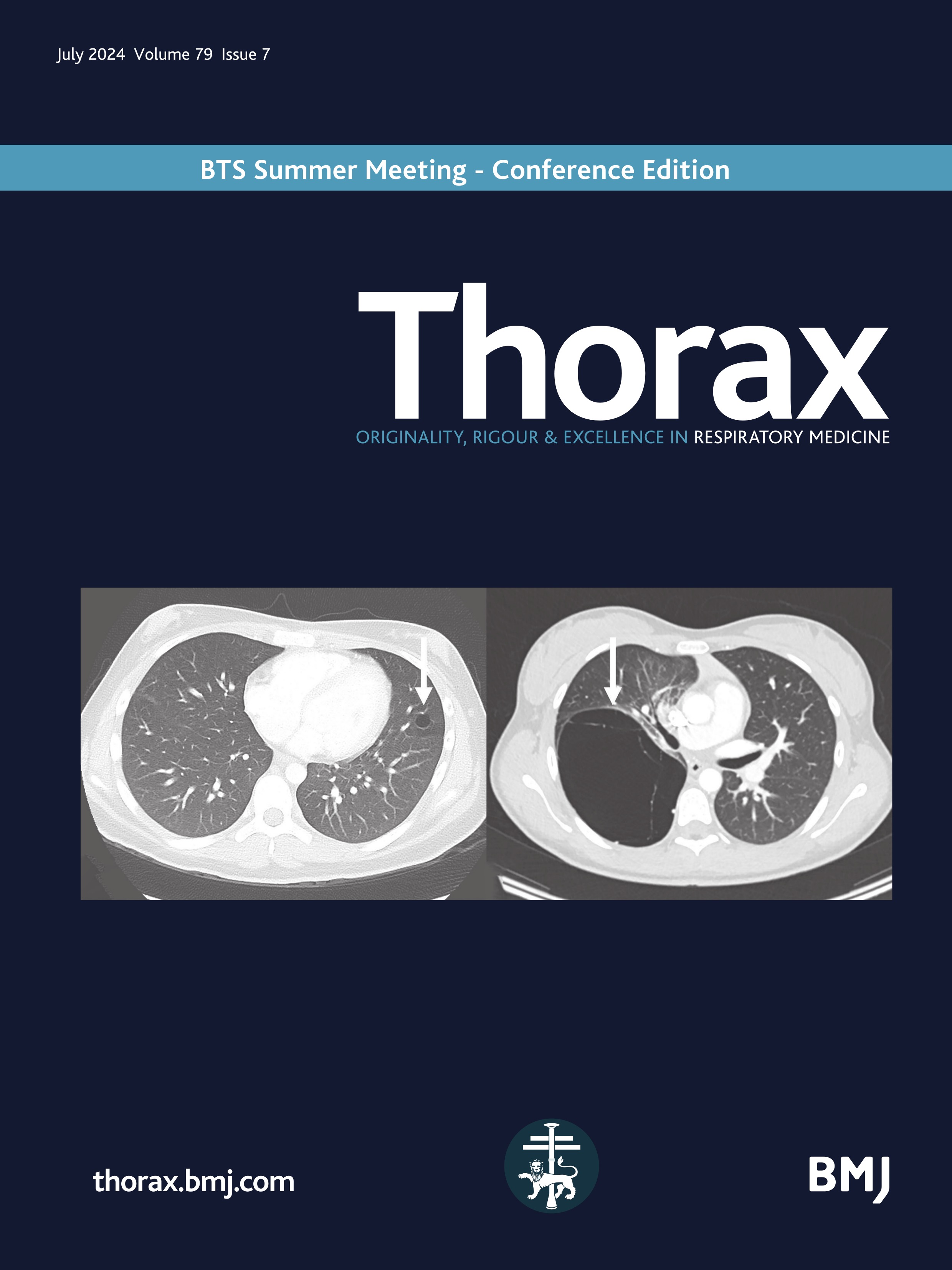 Epidemiology of idiopathic pulmonary fibrosis: opportunities and hurdles for population-level studies of rare disease