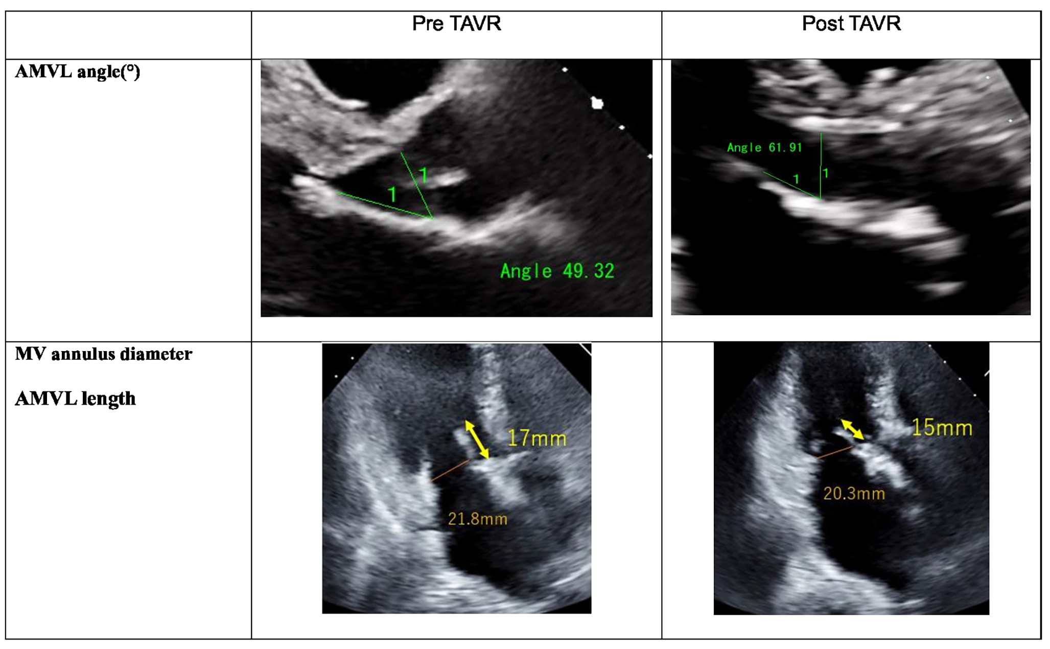 Mitral complex geometric changes aggravate mitral stenosis after transcatheter aortic valve replacement