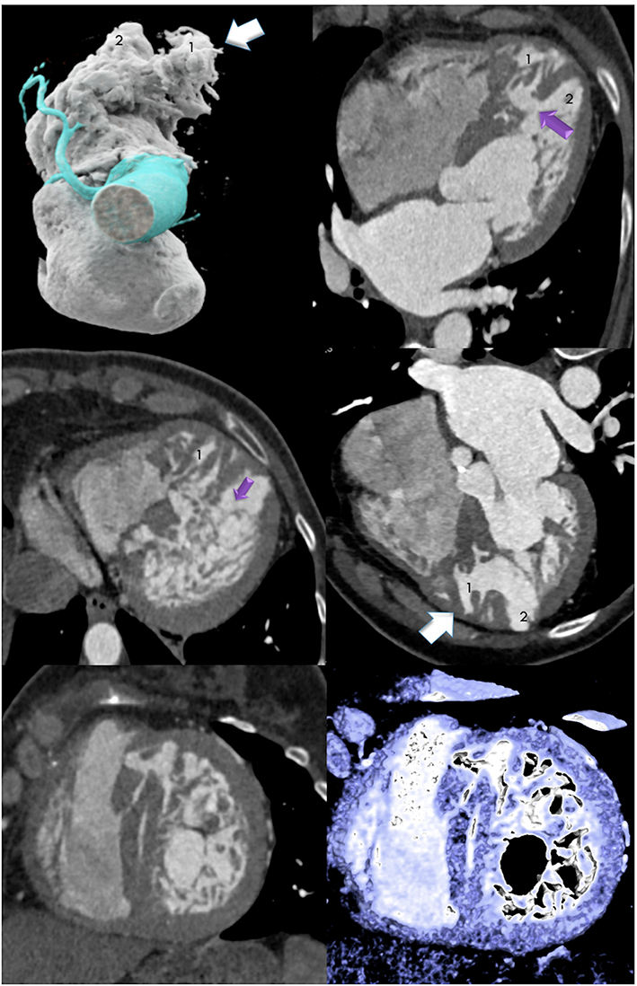 Double Chambered Left Ventricle in a 56-YOF scheduled for transcatheter aortic valve implantation (TAVI) planning incidentally detected by CTA