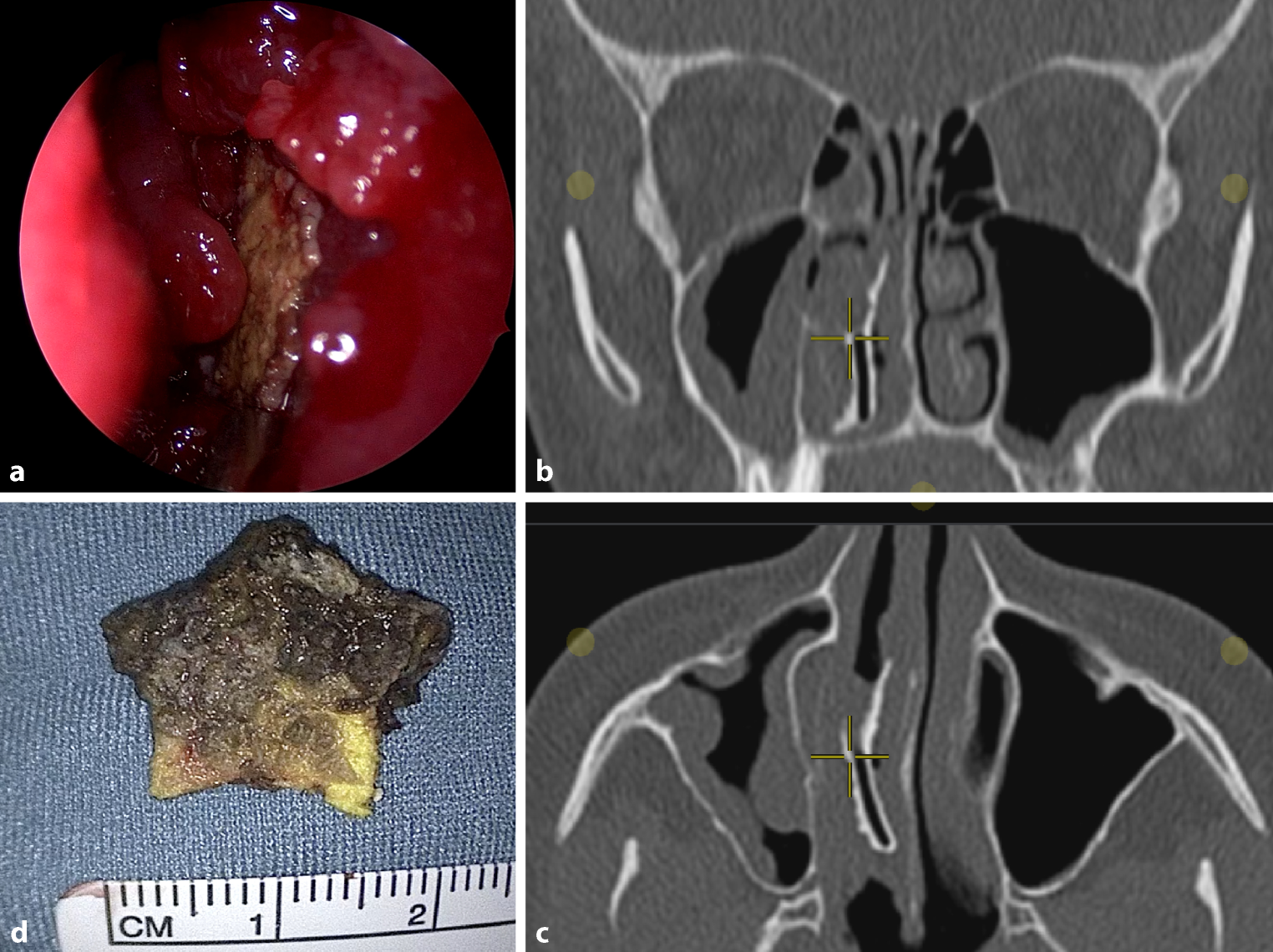 “A star is born”—A unique case of an intranasal foreign body