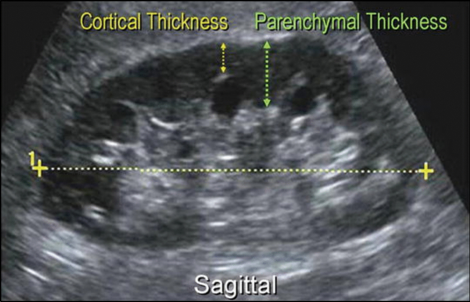 Sonological predictors of complications of percutaneous renal biopsy—a prospective observational study