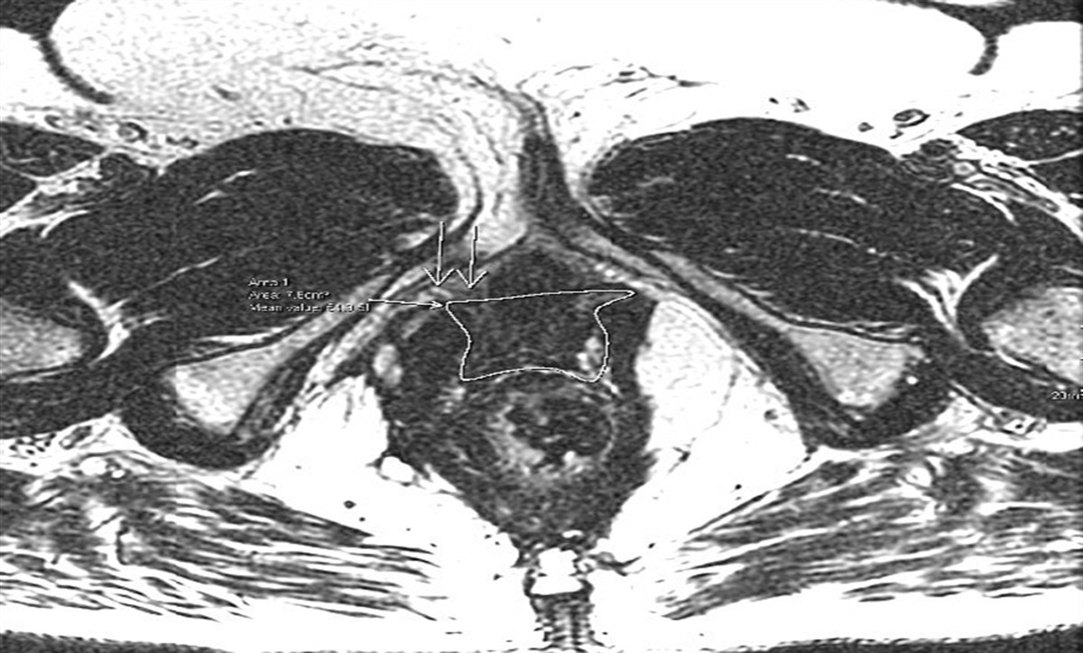 Infection of Obturator Mesh Sling Masquerading as Fistula-in-Ano: A Case Report