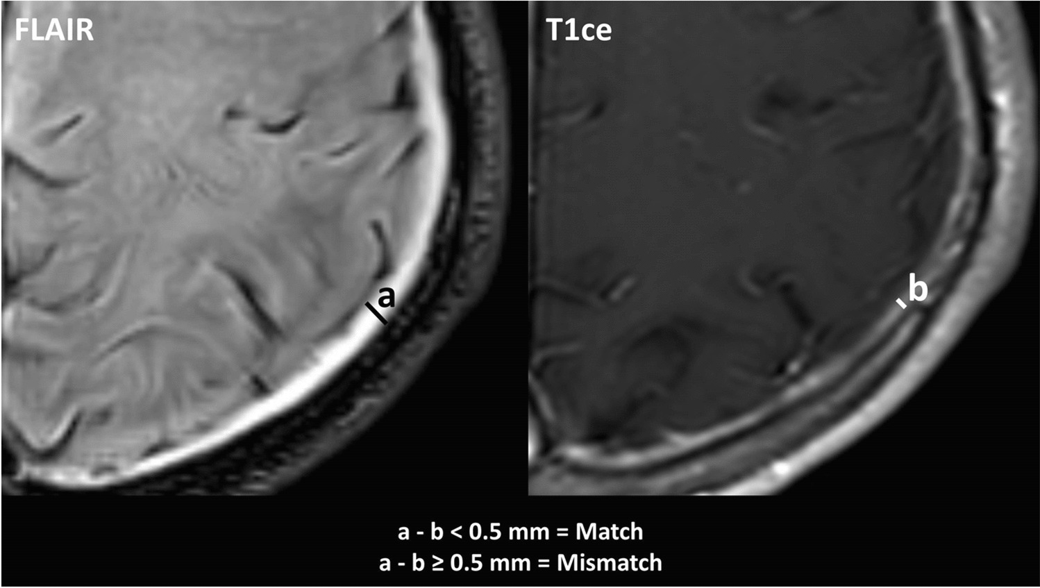 Spontaneous intracranial hypotension: Exploring the viability of non-contrast FLAIR as a substitute for contrast-enhanced T1WI in assessing pachymeningeal thickening