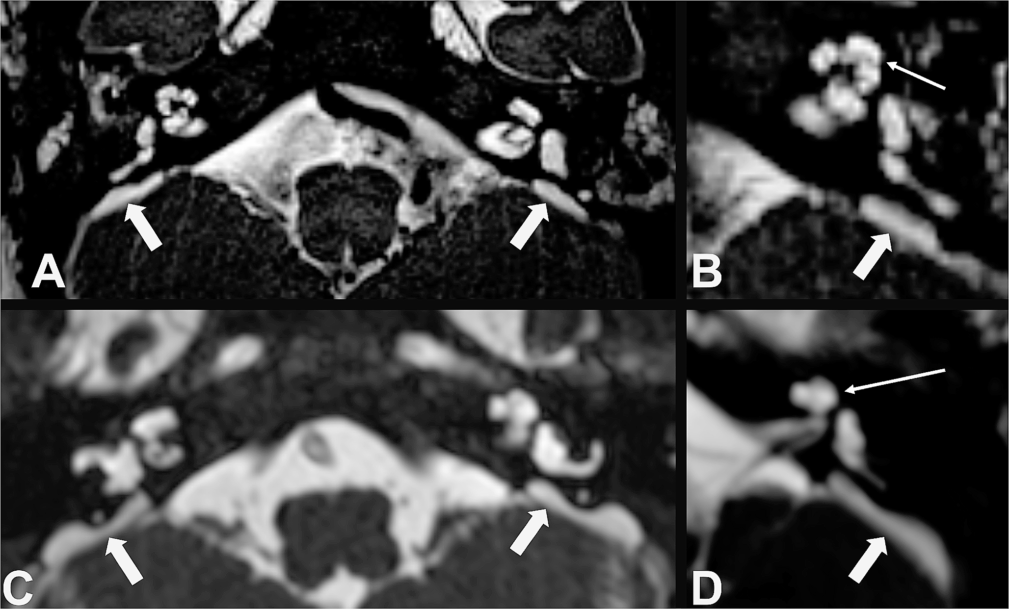 Incomplete partition type II in its various manifestations: isolated, in association with EVA, syndromic, and beyond; a multicentre international study