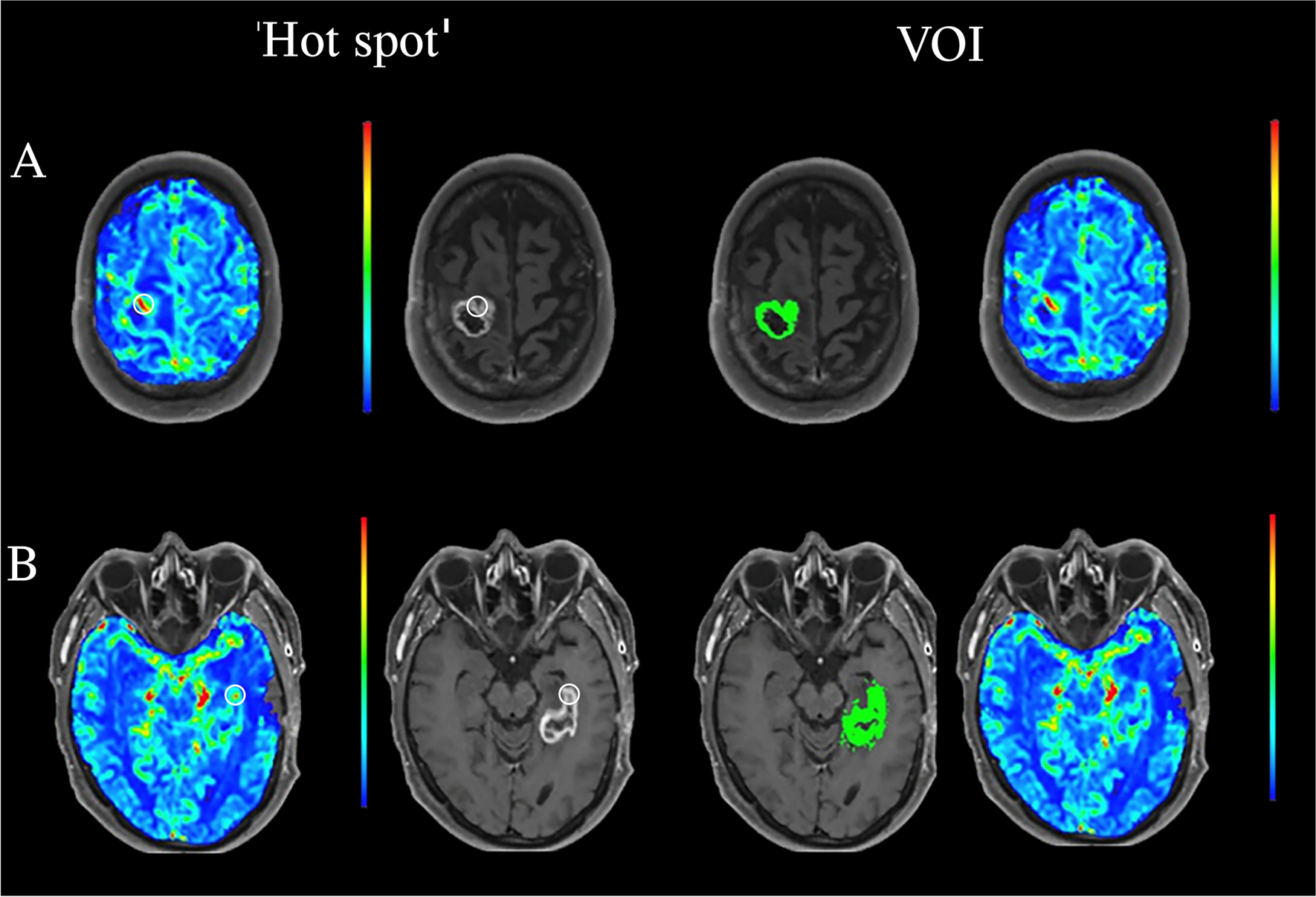 How to evaluate perfusion imaging in post-treatment glioma: a comparison of three different analysis methods