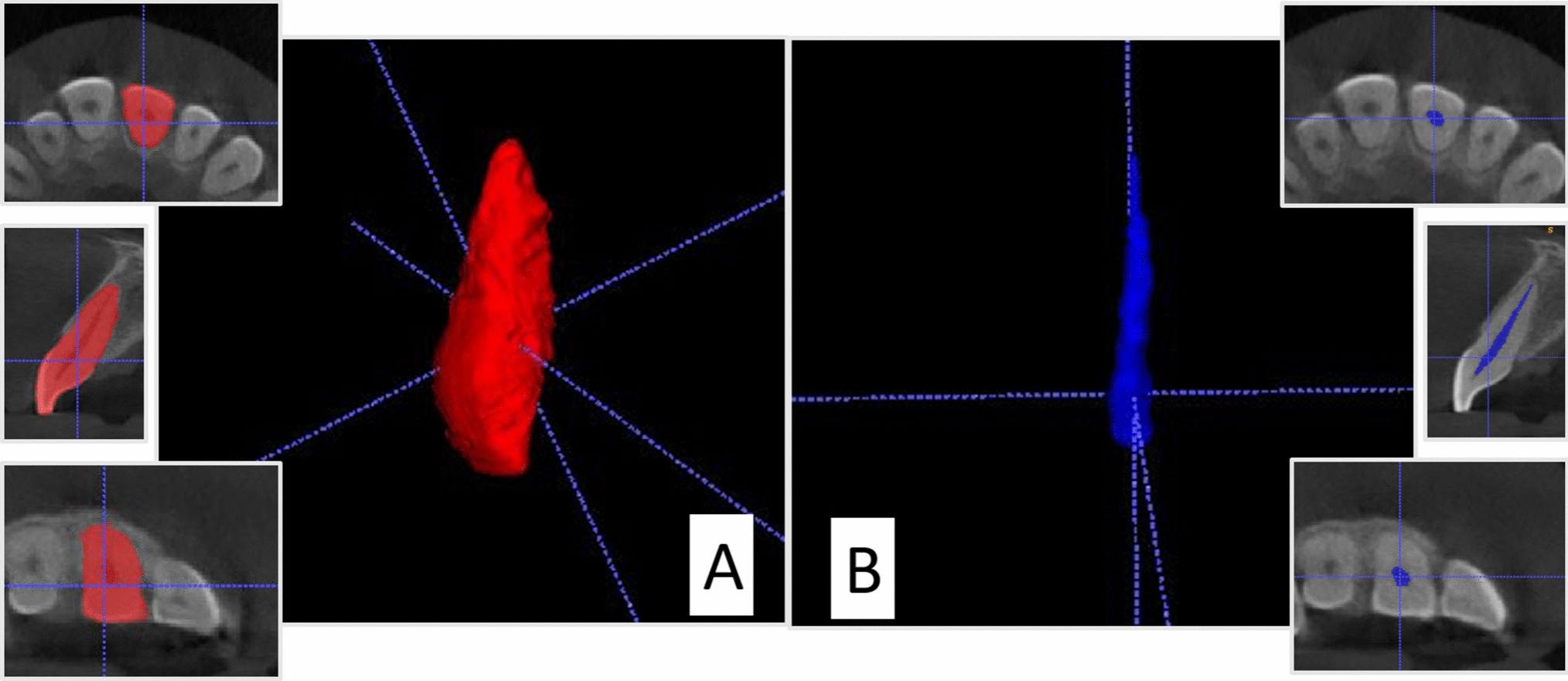 Age estimation by volumetric analysis of teeth using cone beam computed tomography