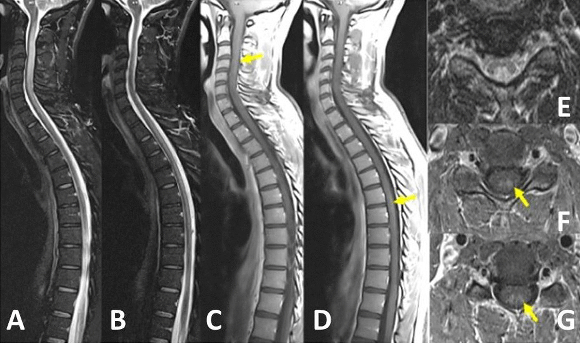 An emerging etiology of spinal cord injury resembling neuromyelitis optica spectrum disorder