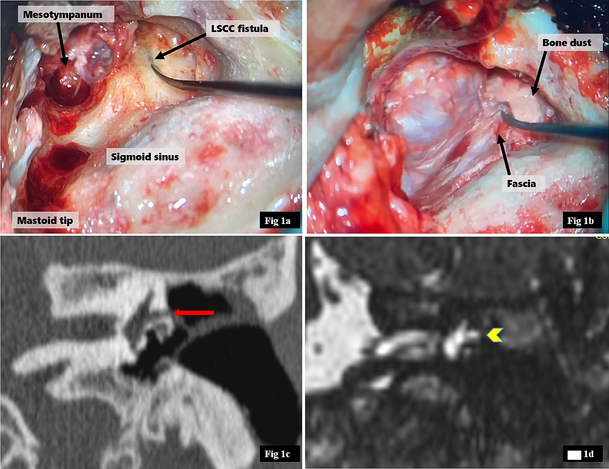 Our Experience with Labyrinthine Fistula: Prospective Hearing Outcomes