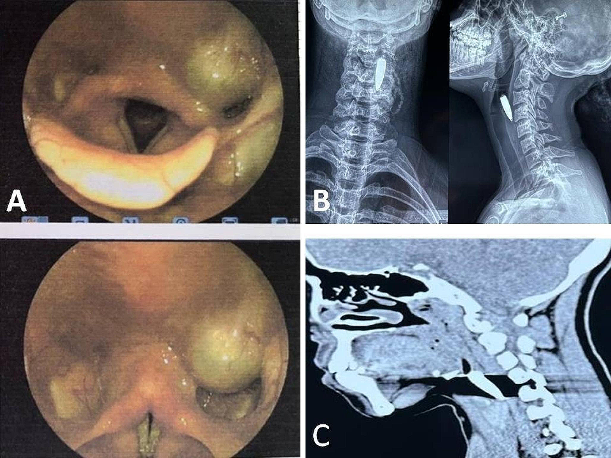 Unusual Migration of Bullet from the Right Scalp to Left Pyriform Fossa