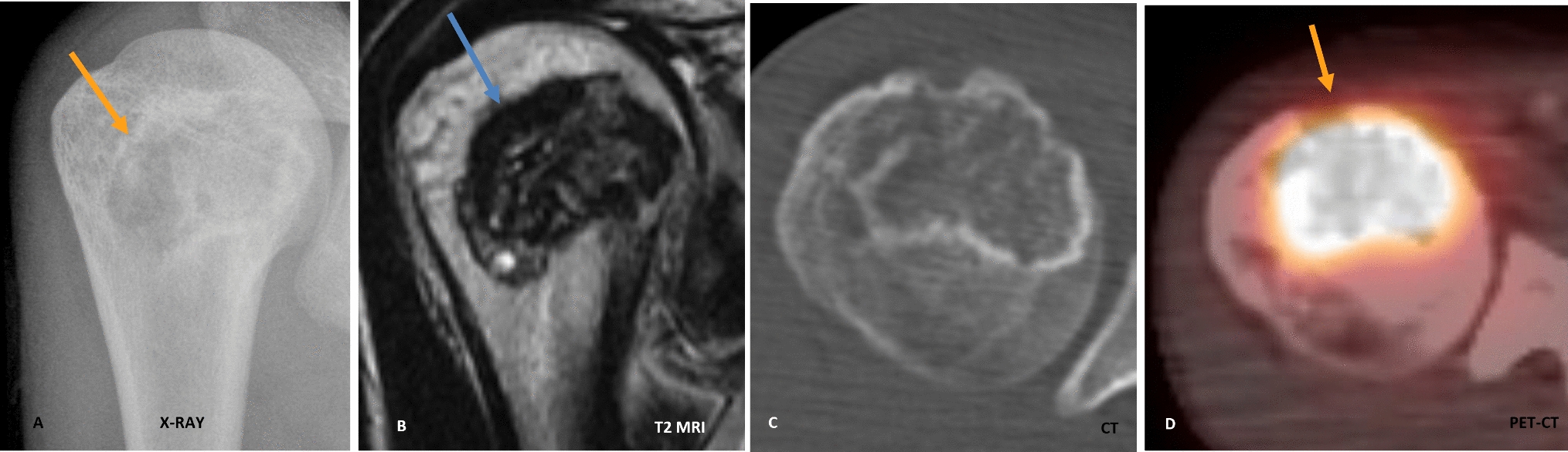 Retrospective Study of Multimodality Imaging Features of Chondroblastoma