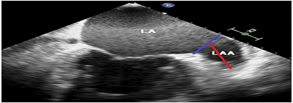 Use of 3D Echocardiography Facilitates Analysis of Thrombolytic Efficacy in Patients With Persistent Atrial Fibrillation