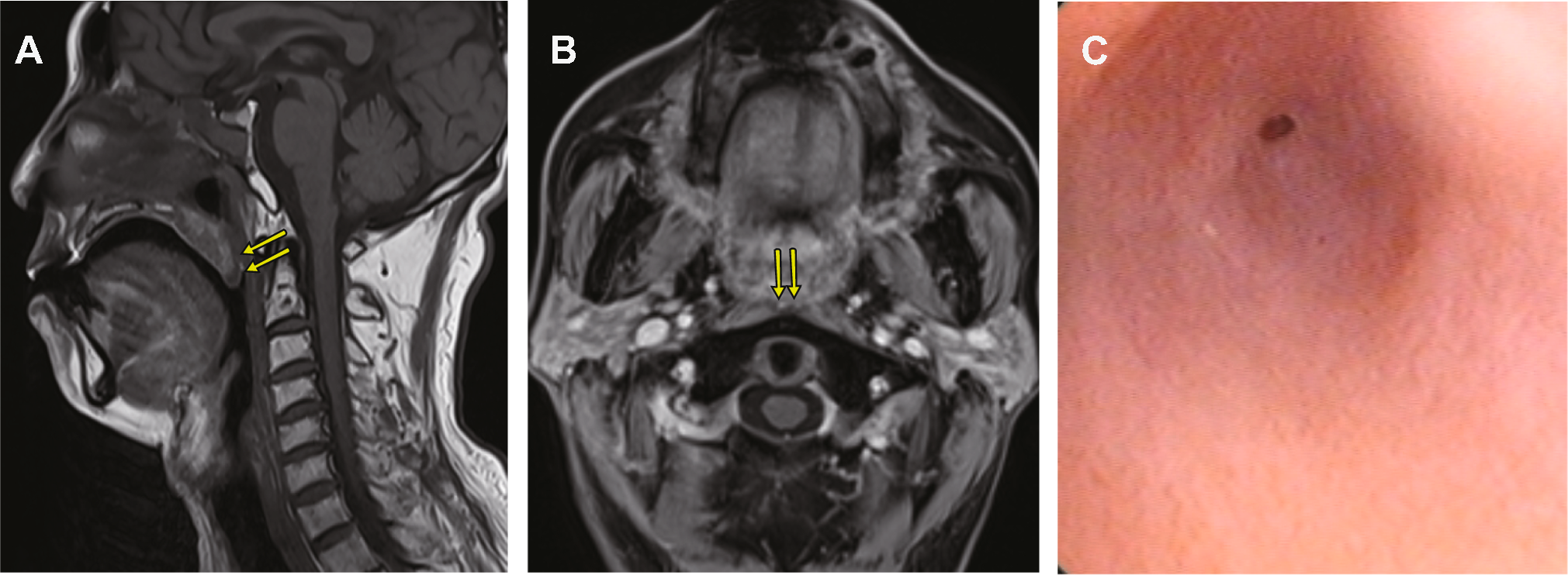 Fluoroscopy-Guided Balloon Dilation for Severe Nasopharyngeal Stenosis Resulting from Radiotherapy for Nasopharyngeal Carcinoma