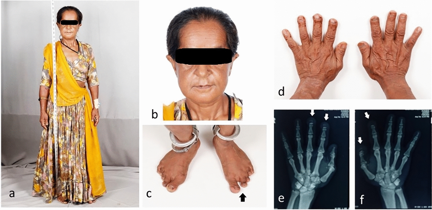 Osteopetrosis or Pycnodysostosis?