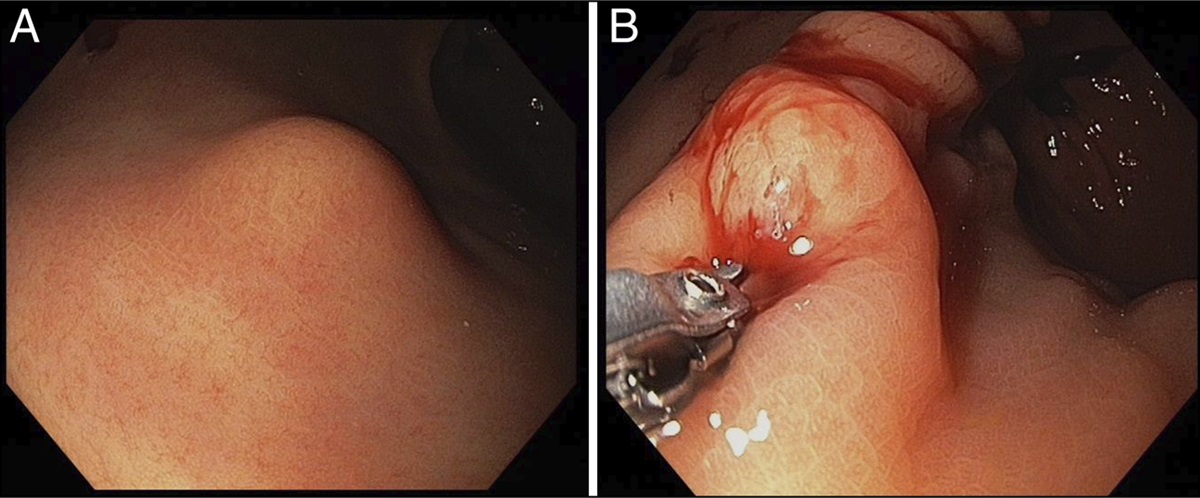 Combining Endoscopic Submucosa Dissection and Endoscopic Full-Thickness Resection for Resection of a Gastric Schwannoma Mimicking Gastrointestinal Stroma Tumor