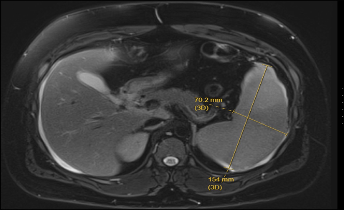 A Real Gut Punch: An Unexpected Diagnosis of Spontaneous Splenic Rupture