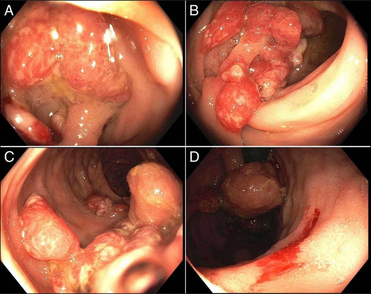 Ulcerative Colitis or Not? A Case of Dysplasia, Gastrointestinal Bleeding, and Juvenile Polyposis in a 27-Year-Old Man