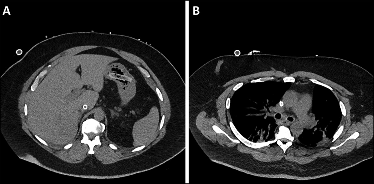 Tracheal Stent Ingestion: Unveiling Complications and Innovations in Management