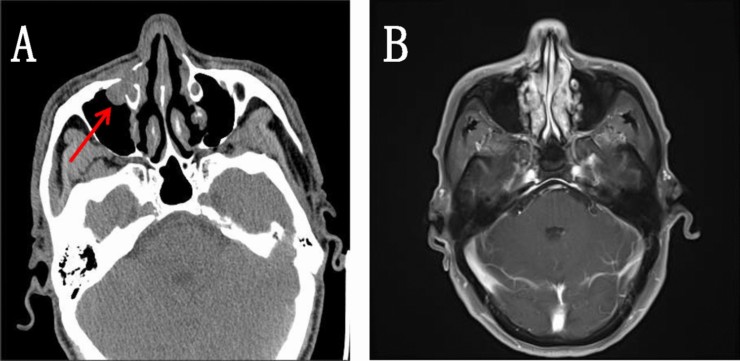 A case of high-grade non-intestinal paranasal sinus adenocarcinoma primary in the maxillary sinus: targeted therapy after postoperative immunocombination with chemotherapy