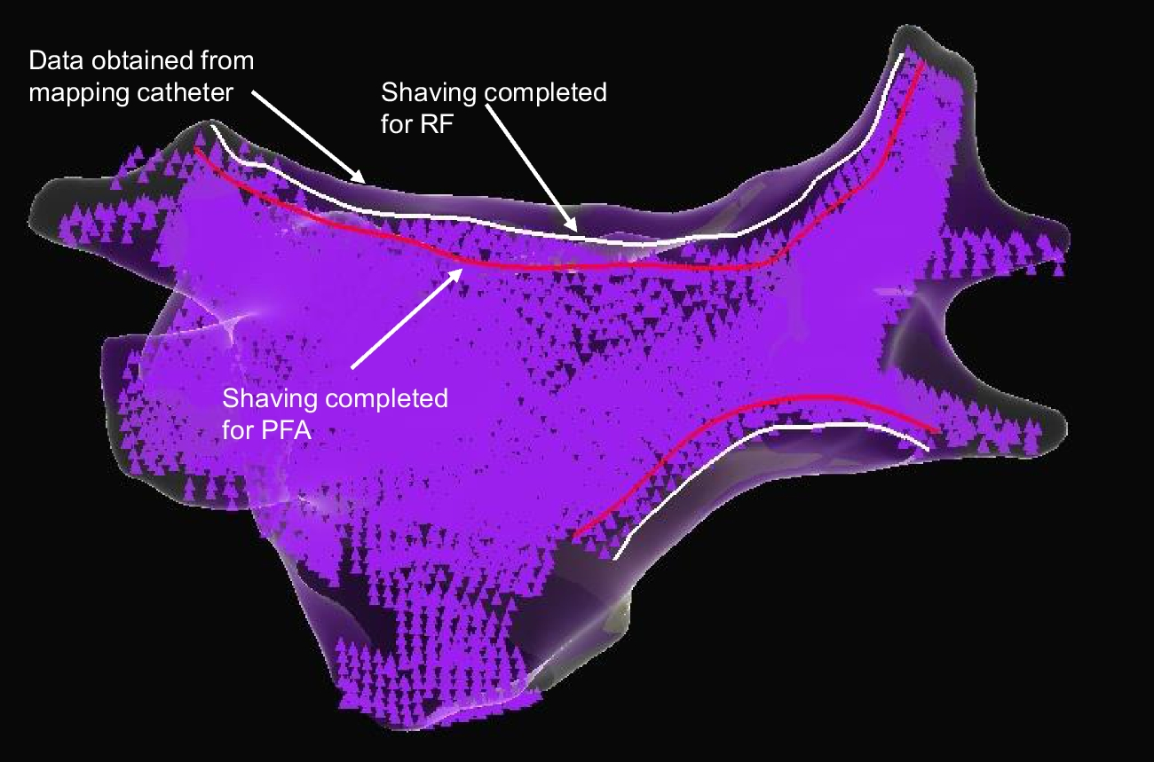 Pulsed-field ablation for atrial fibrillation without the use of fluoroscopy