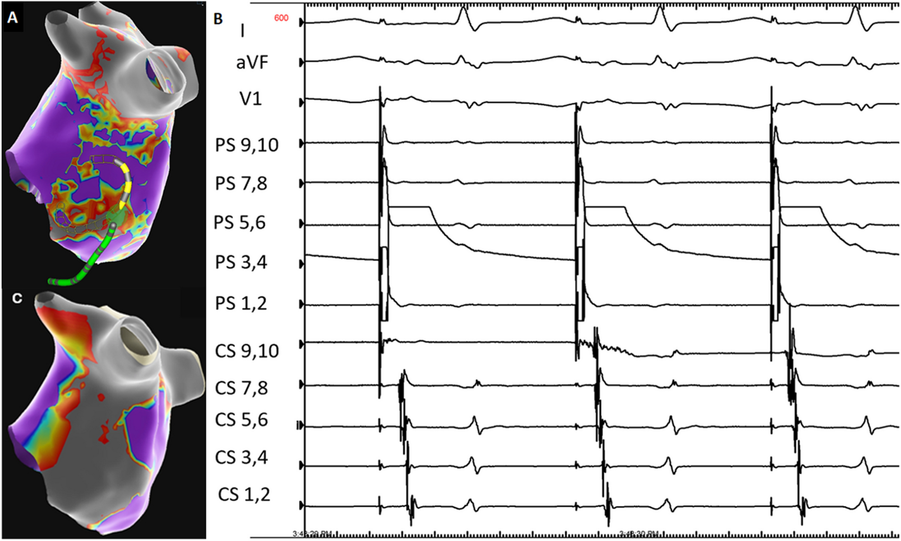 Achieving a steady pulse with pulse field ablation