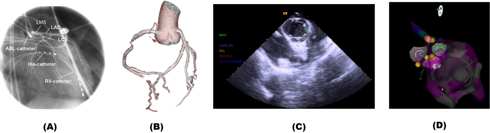 Implications of the cadaveric heart dissection for cardiac electrophysiology and atrial fibrillation ablation: global electrophysiology perspective