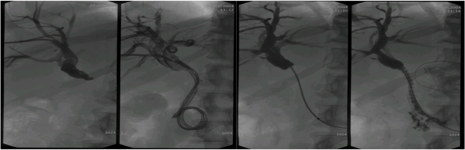 Percutaneous Metallic Stents in Malignant Biliary Obstruction: Comparison of Nitinol and Wall Stents