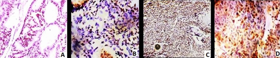 Expression Pattern of Estrogen Receptor Alpha and Progesterone Receptor in Gallbladder Carcinoma and Their Association with Clinicopathological Parameters and Overall Survival