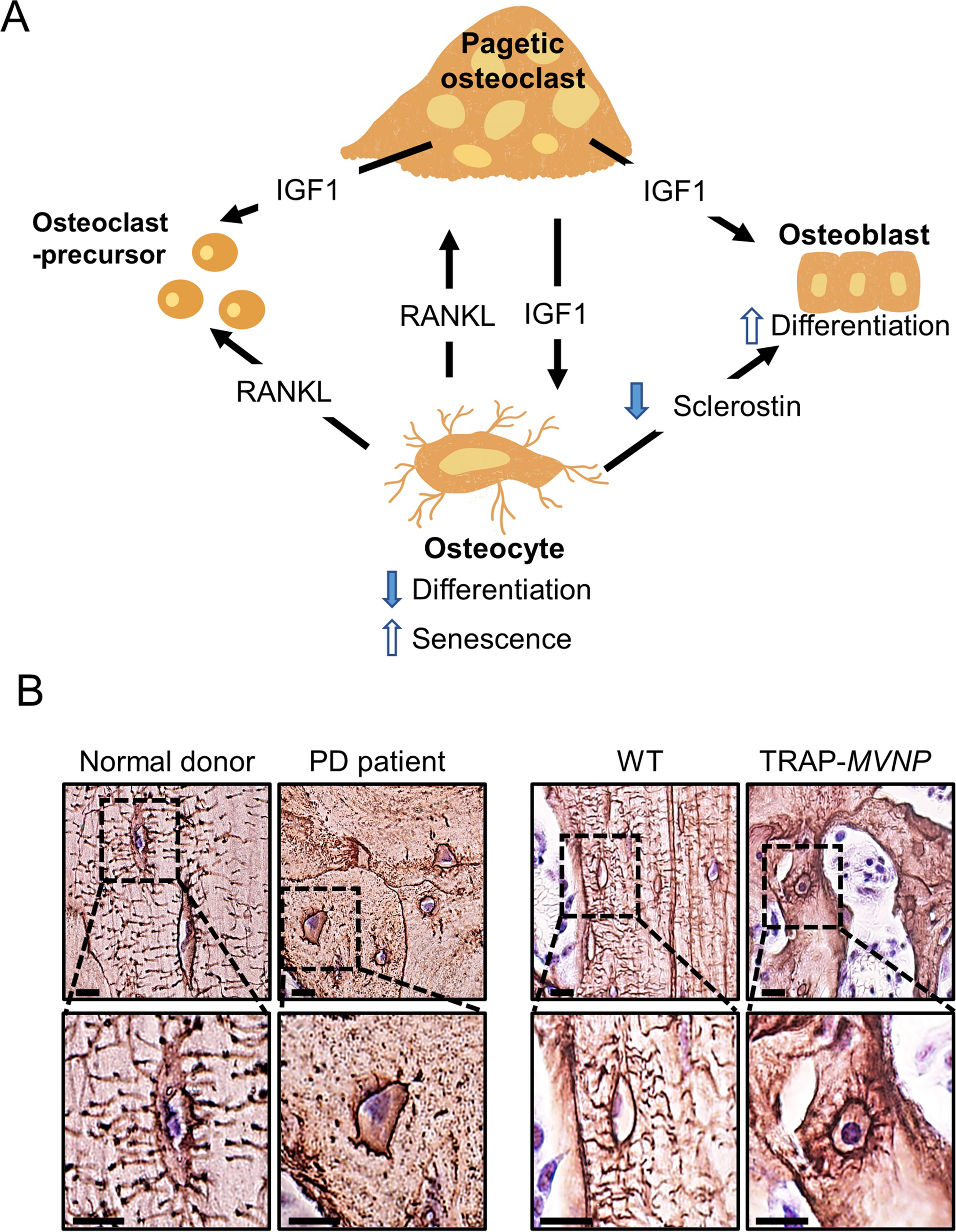 Osteocytes and Paget’s Disease of Bone