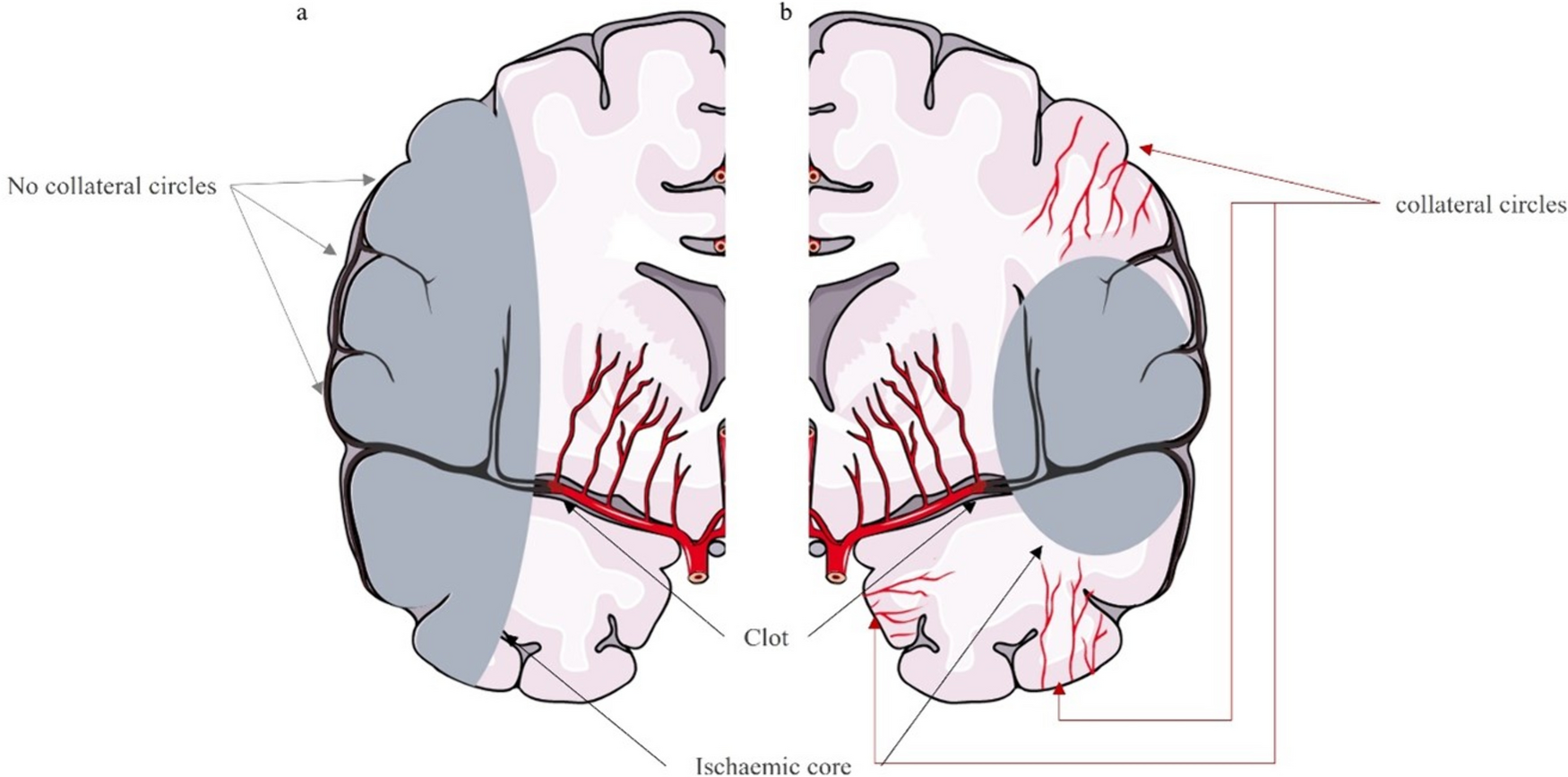 Delving Into the Significance of Brain’s Collateral Circulation in the Era of Revascularization Therapy