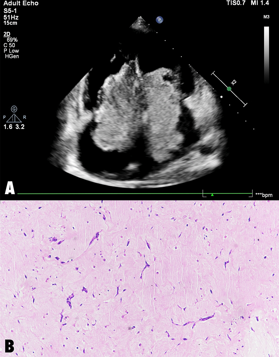 Bilateral myxoma presenting as multi-valvular heart disease