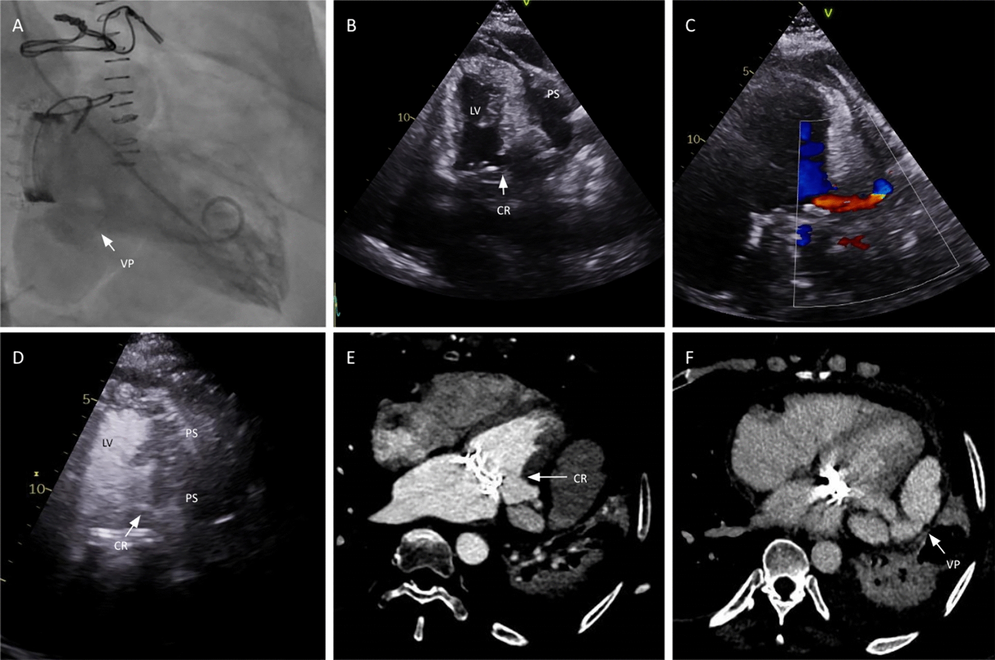 Evolved cardiac rupture: an unusual complication and a rare presentation after heart valve surgery. a case report