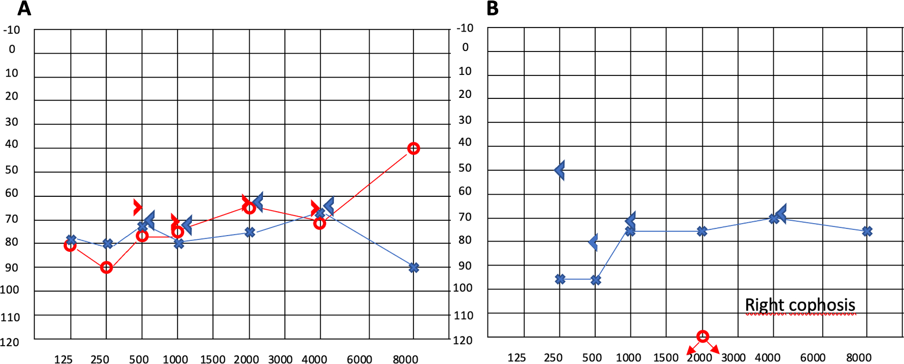 Cochlear implants for hereditary ATTR amyloidosis: a case report of two cases