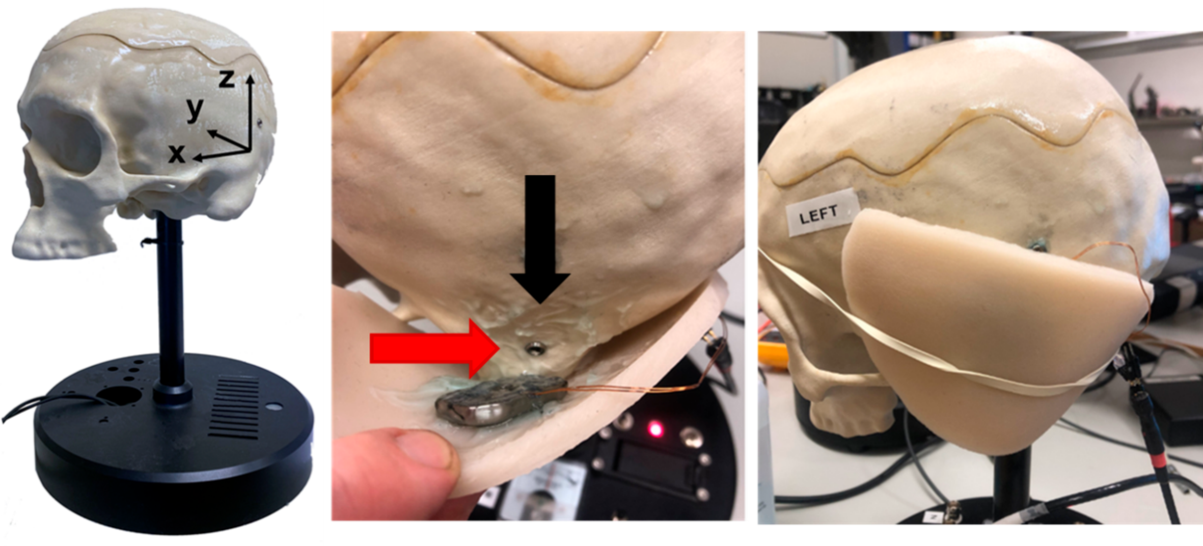 Minimally invasive subperiosteal pocket technique for Osia 2 system- implantation without fixation