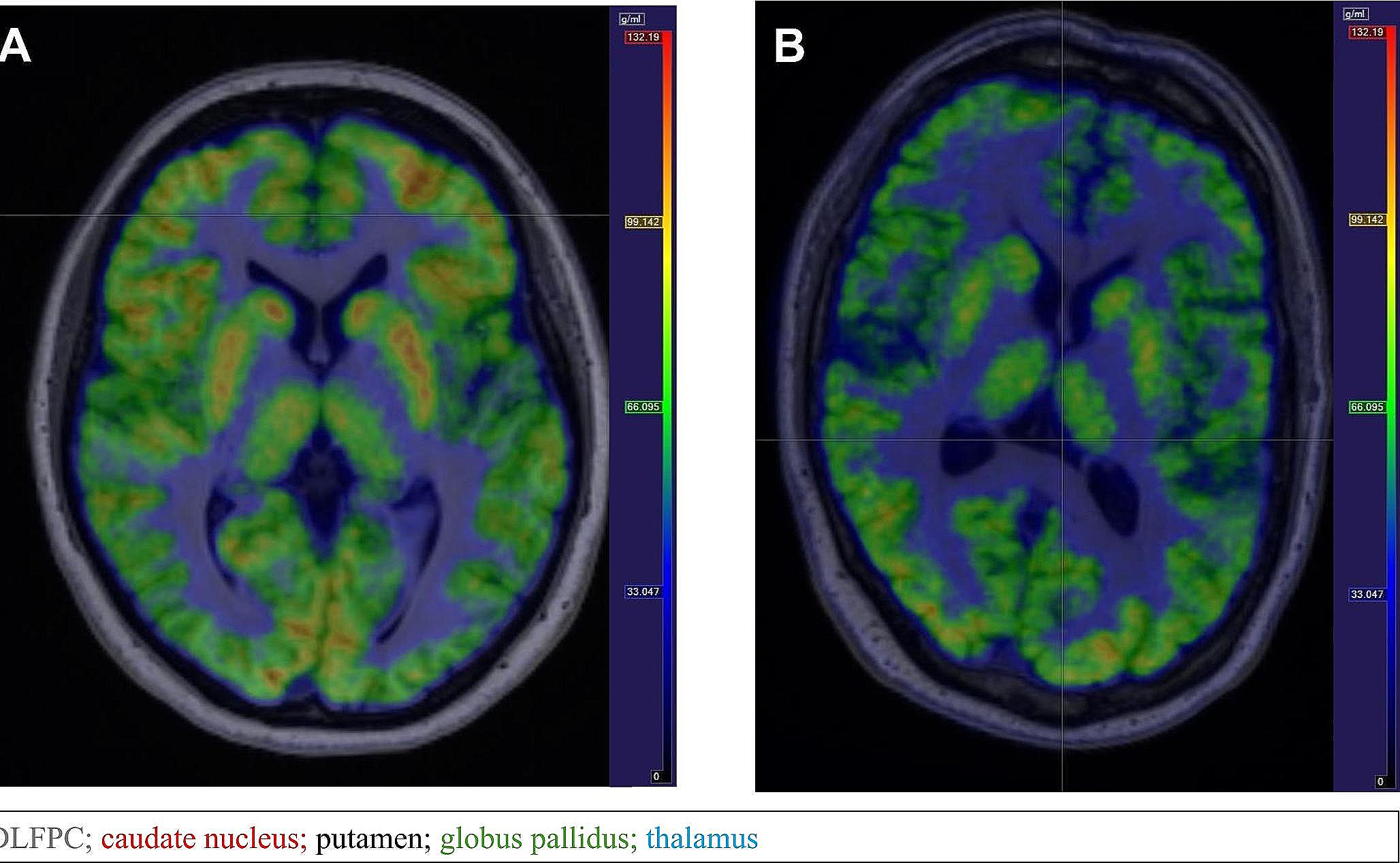 Frontal-striatal glucose metabolism and fatigue in patients with multiple sclerosis, long COVID, and COVID-19 recovered controls