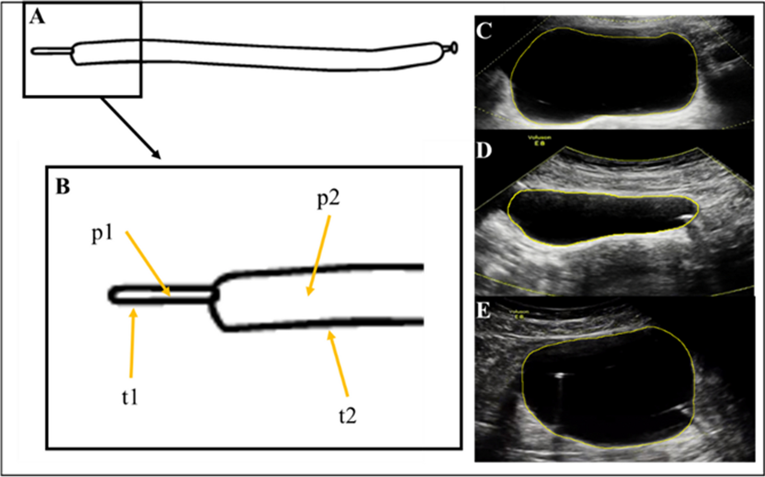 Ultrasound Urodynamics: A Review of Ultrasound Imaging Techniques for Enhanced Bladder Functional Diagnostics