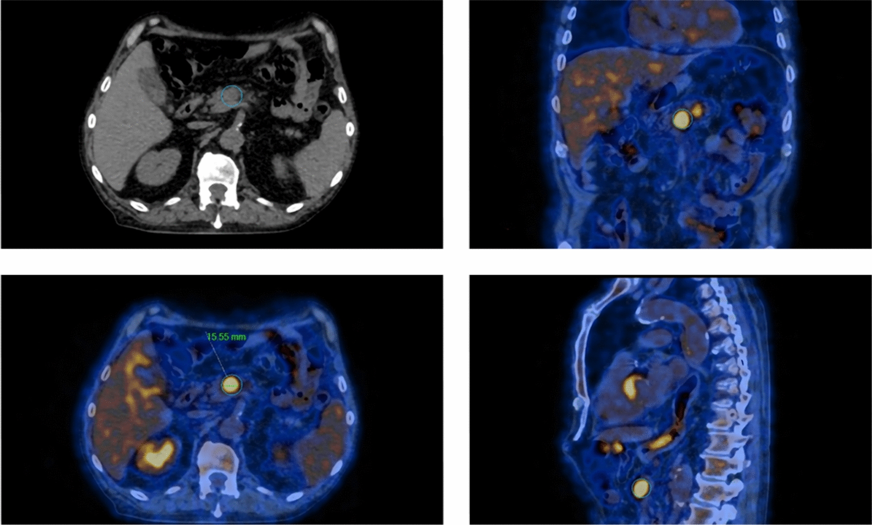 The role of 18FDG–PET imaging in VEXAS syndrome: a multicentric case series and a systematic review of the literature