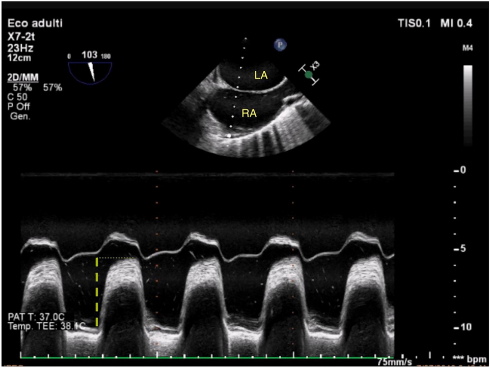 Echocardiographic clues of the “atrial pump mechanism” during cardiopulmonary resuscitation