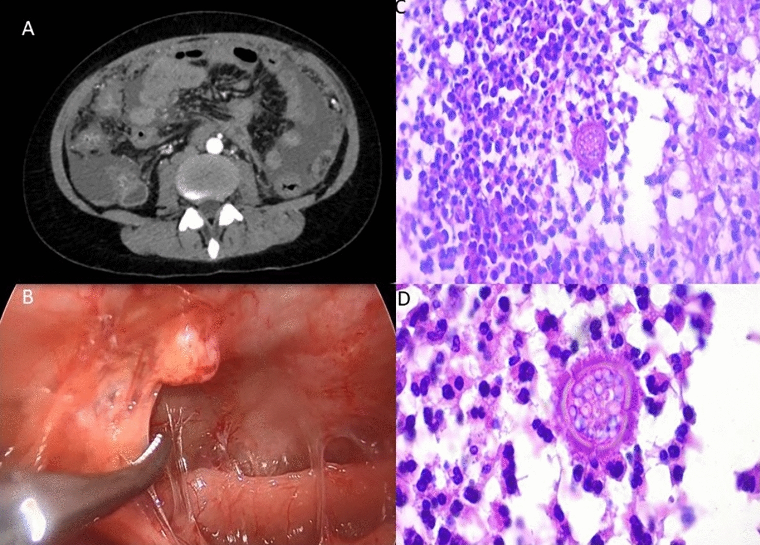 Thinking beyond the basic differential diagnosis of abdominal pain: a case of peritoneal coccidioidomycosis