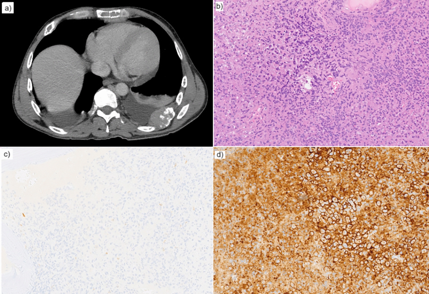 Unusual plasmablastic subtype of multiple myeloma in a young adult