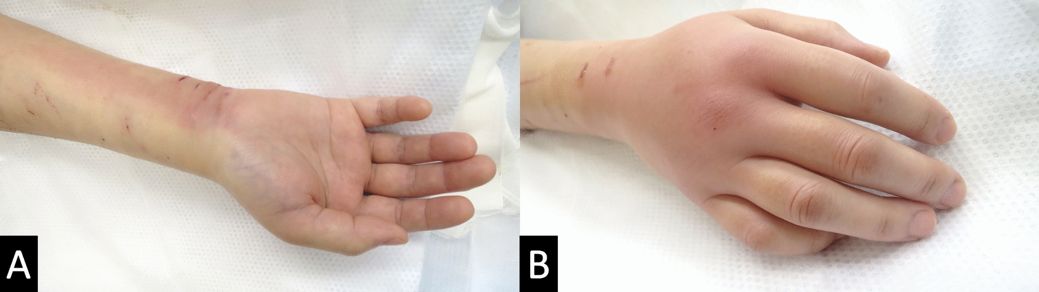 Kanavel signs: pyogenic flexor tenosynovitis