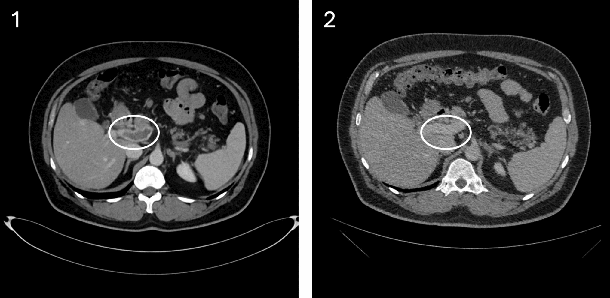 Less is not always more: complex interactions in blood clot mysteries